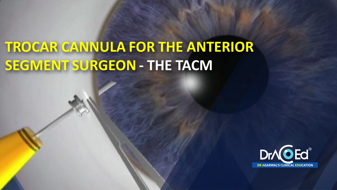 TROCAR CANNULA FOR THE ANTERIOR SEGMENT SURGEON - THE TACM